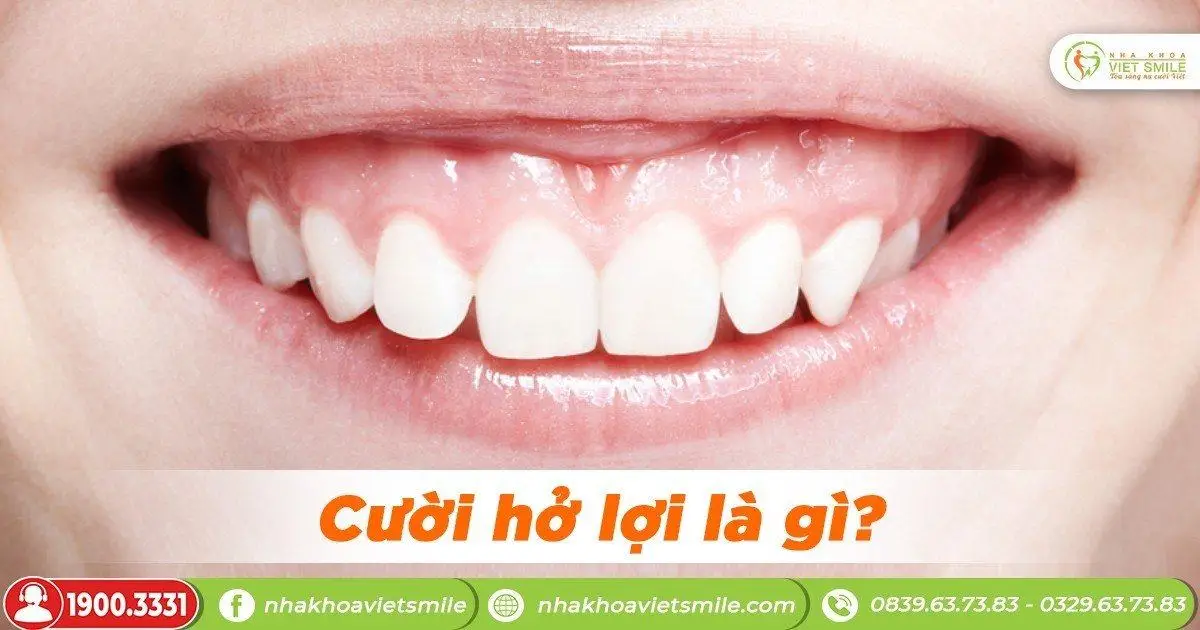 Cười hở lợi là gì?