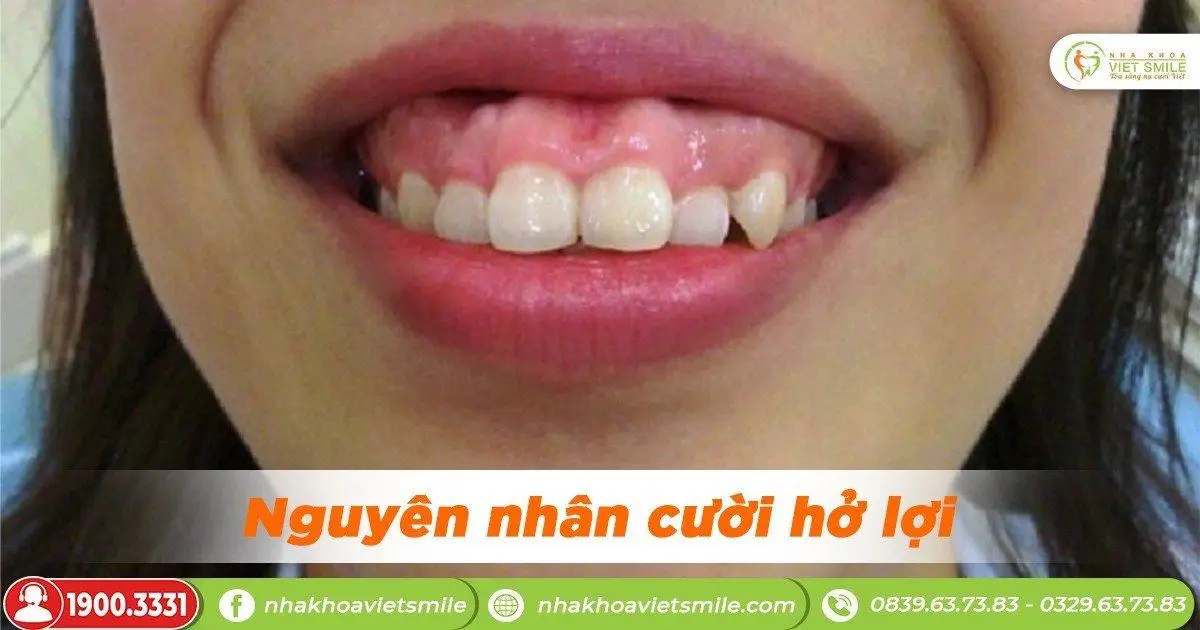 Nguyên nhân cười hở lợi là gì?