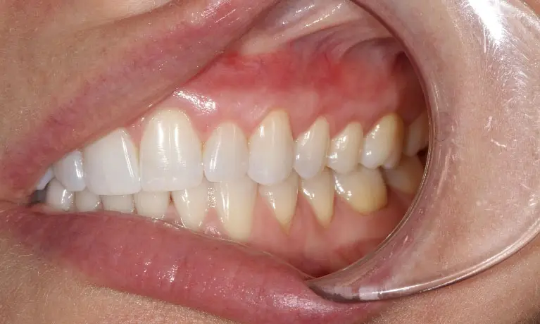 Nguyên nhân bị tụt lợi