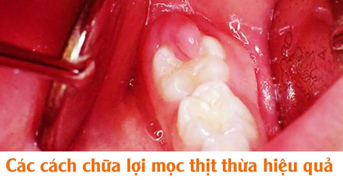 Các cách chữa lợi mọc thịt thừa hiệu quả