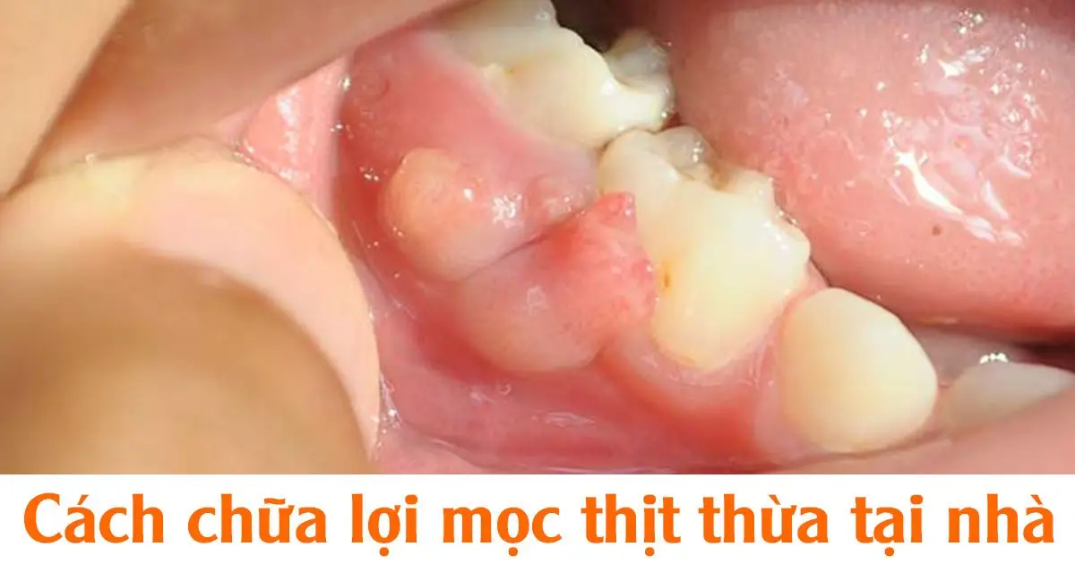 Cách chữa lợi mọc thịt thừa tại nhà