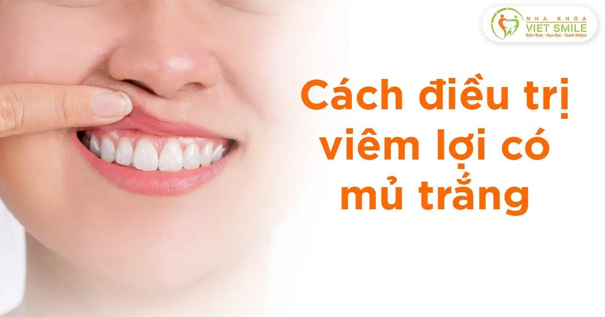 Cách điều trị viêm lợi có mủ trắng
