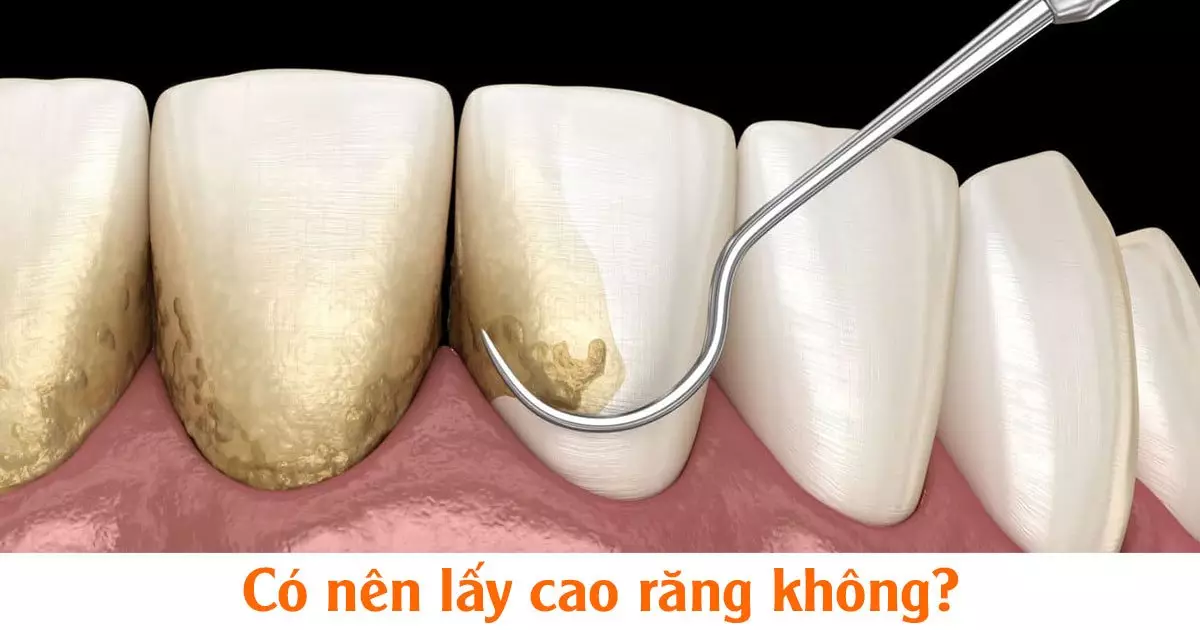 Có nên lấy cao răng không?
