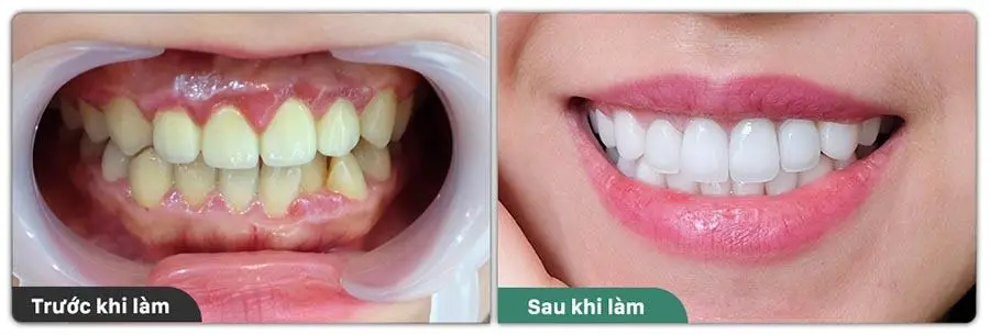 Điều trị viêm lợi giảm cười hở lợi