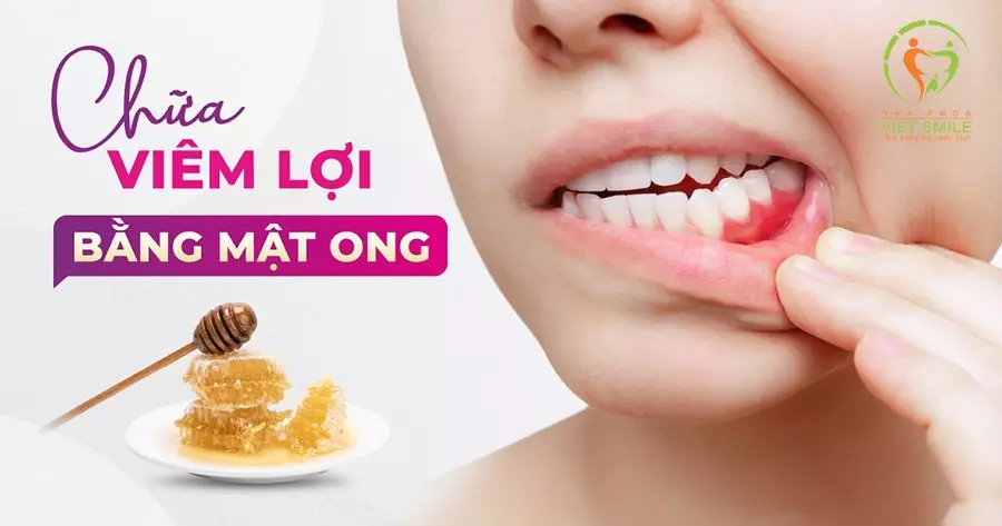Dùng mật ong để chữa viêm nướu