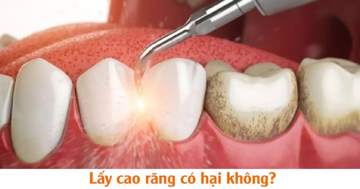 Nguyên nhân hình thành cao răng