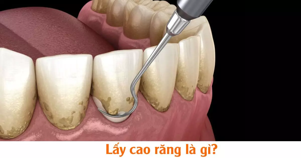 Lấy cao răng là gì?