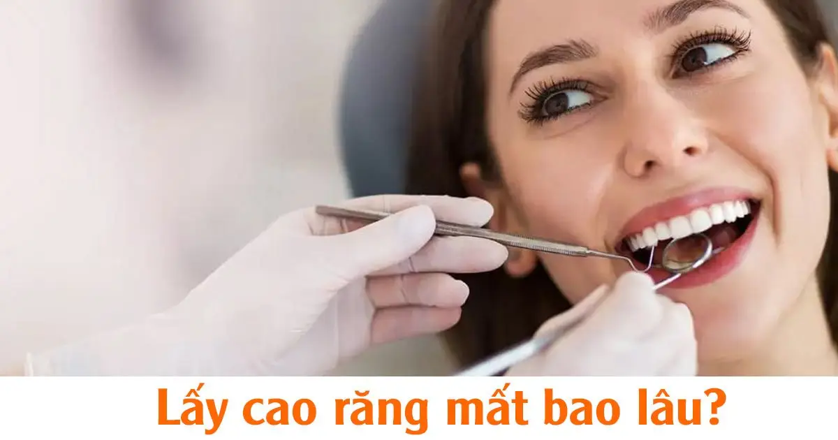 Lấy cao răng mất bao lâu?