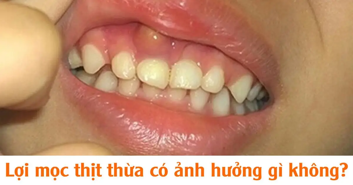 Lợi mọc thịt thừa có ảnh hưởng gì không?