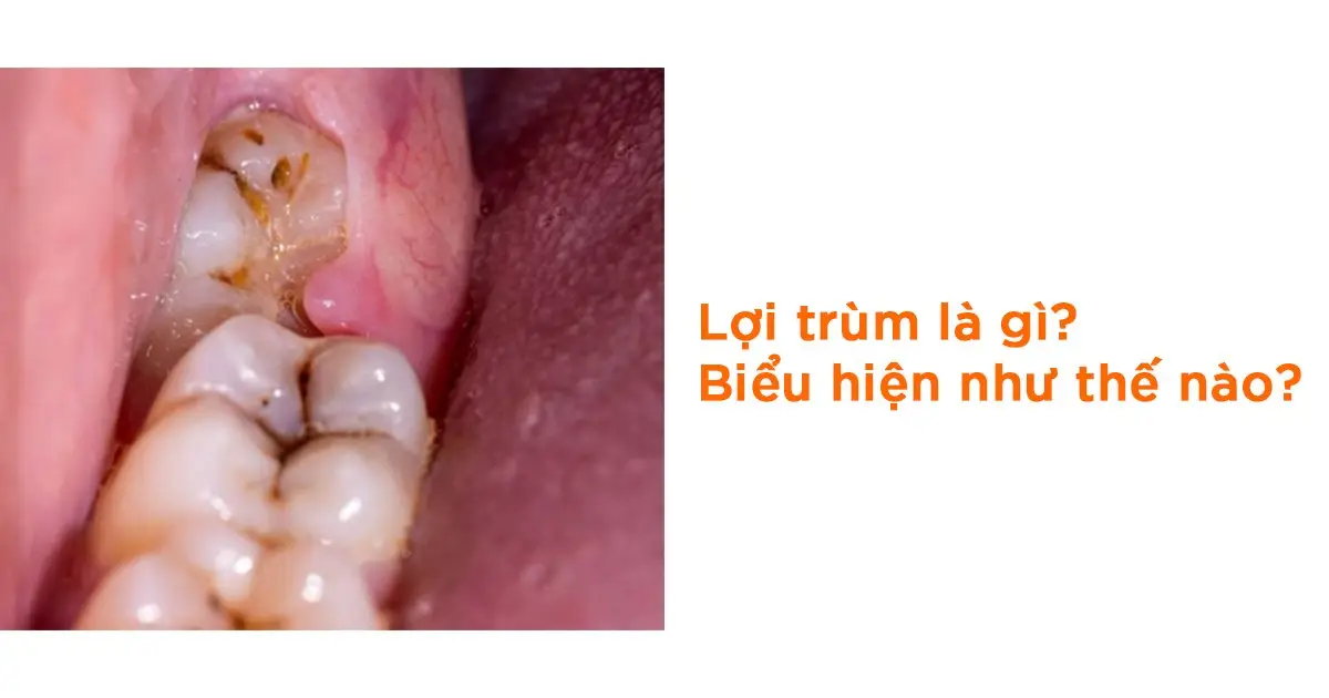 Lợi trùm là gì? Biểu hiện như thế nào?
