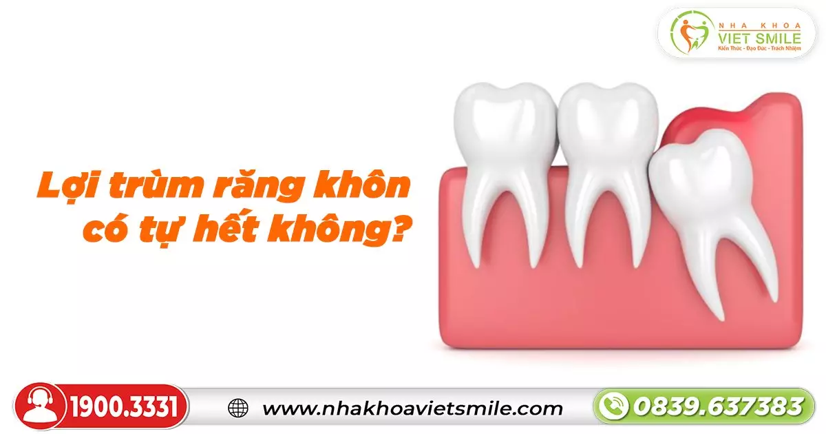 Lợi trùm răng khôn có tự hết không?