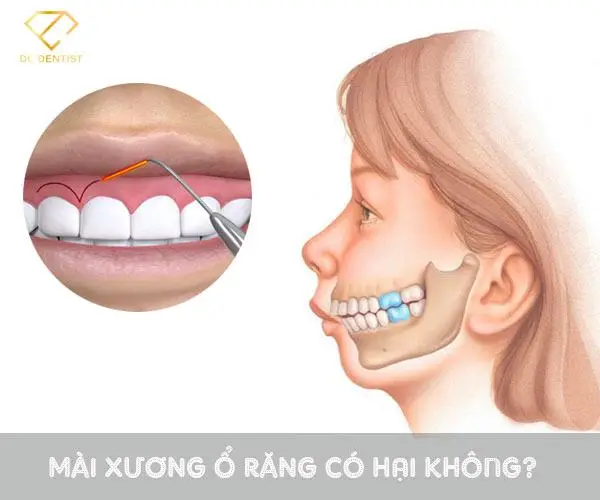 Mài xương ổ răng có nguy hiểm không