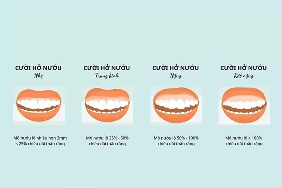 Mức độ cười hở lợi