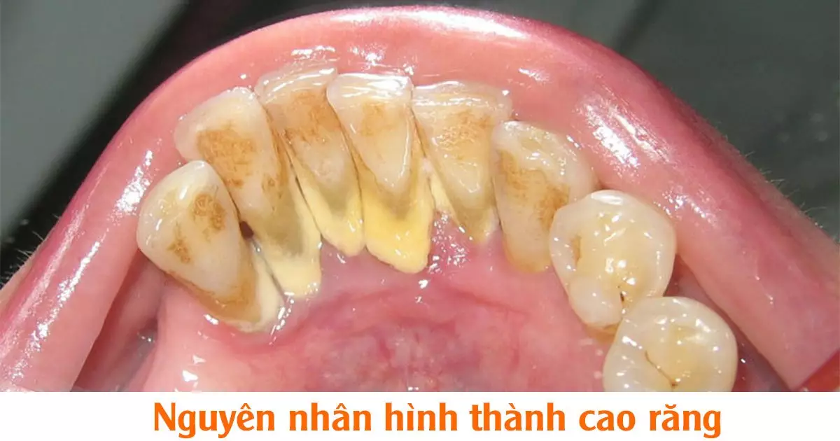 Nguyên nhân hình thành cao răng