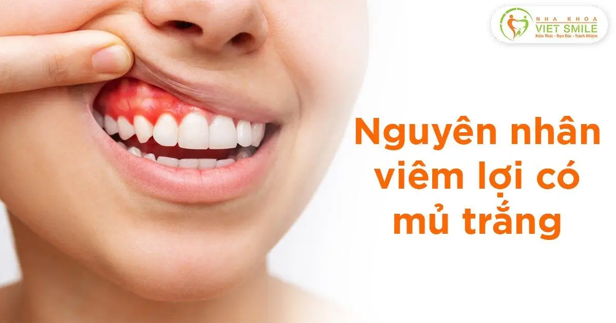 Nguyên nhân viêm lợi có mủ trắng