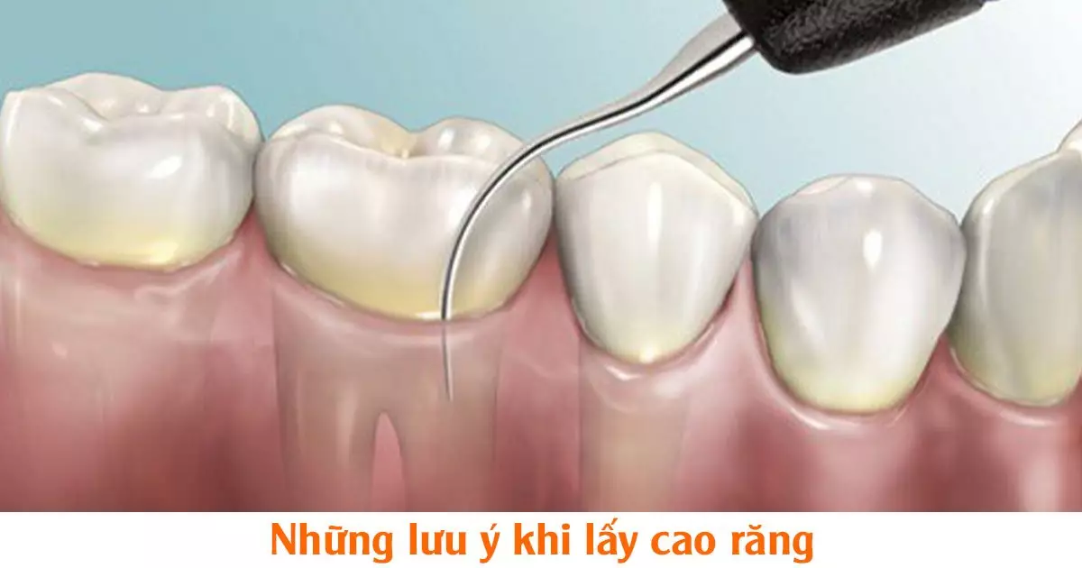 Những lưu ý khi lấy cao răng