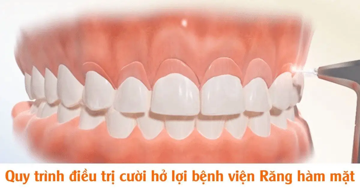 Quy trình điều trị cười hở lợi bệnh viện Răng hàm mặt