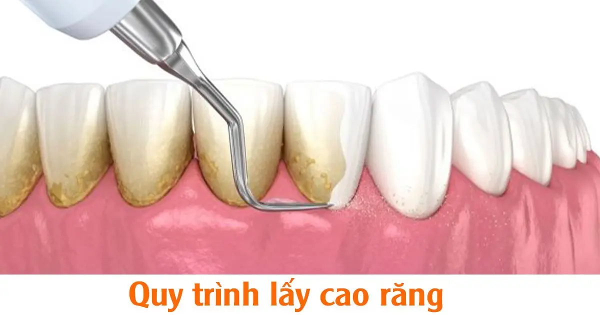 Quy trình lấy cao răng