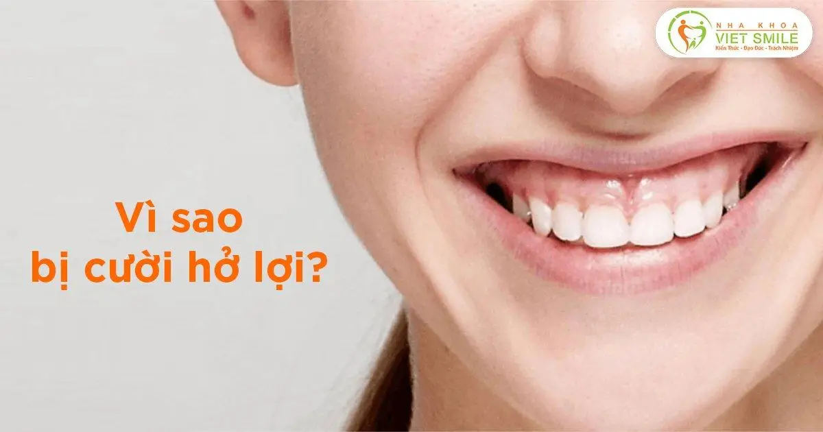Vì sao bị cười hở lợi?