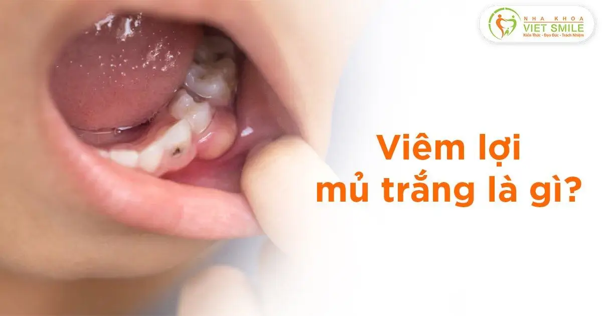 Viêm lợi có mủ trắng là gì?