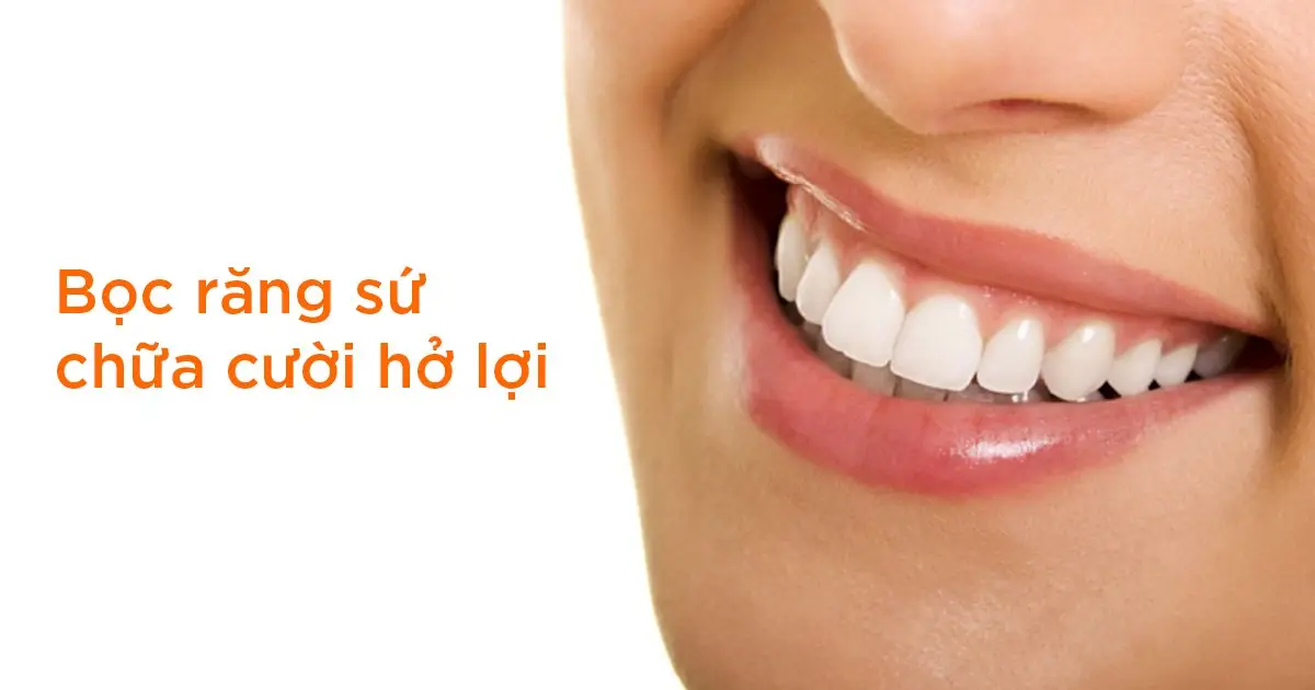 Bọc răng sứ chữa cười hở lợi
