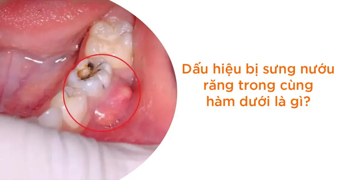 Dấu hiệu bị sưng nướu răng trong cùng hàm dưới là gì?