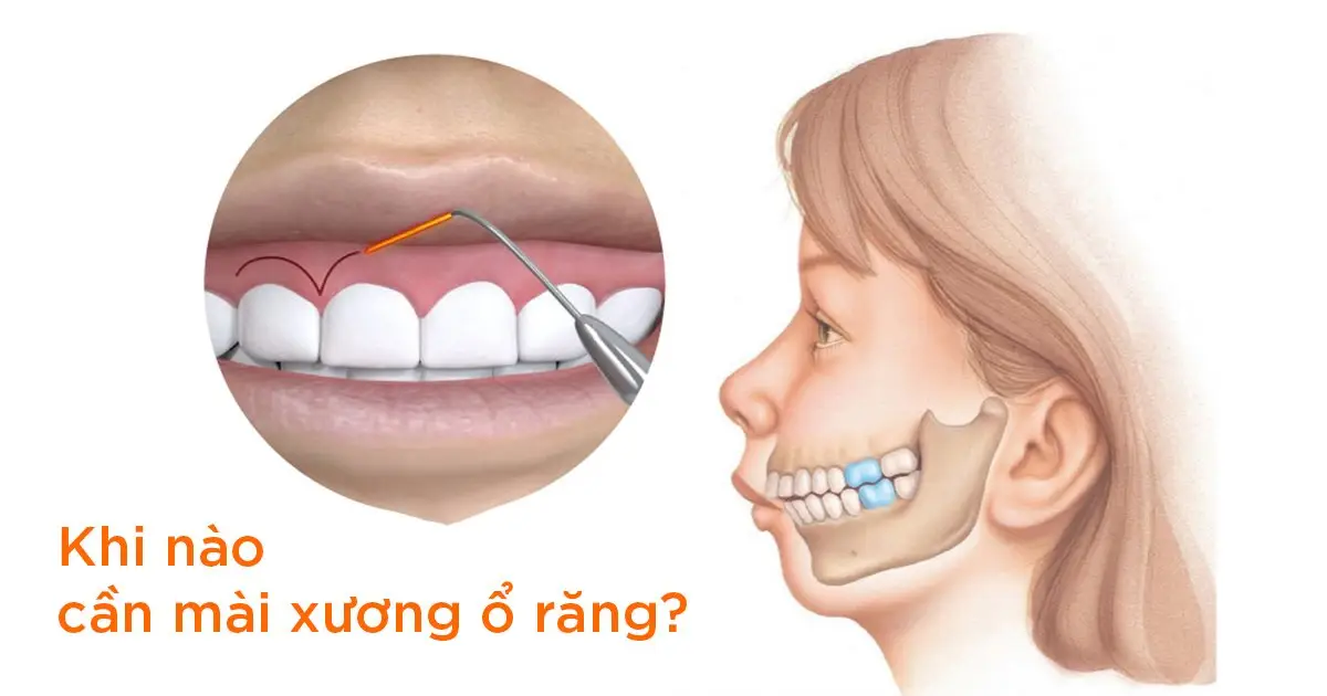 Khi nào cần mài xương ổ răng?