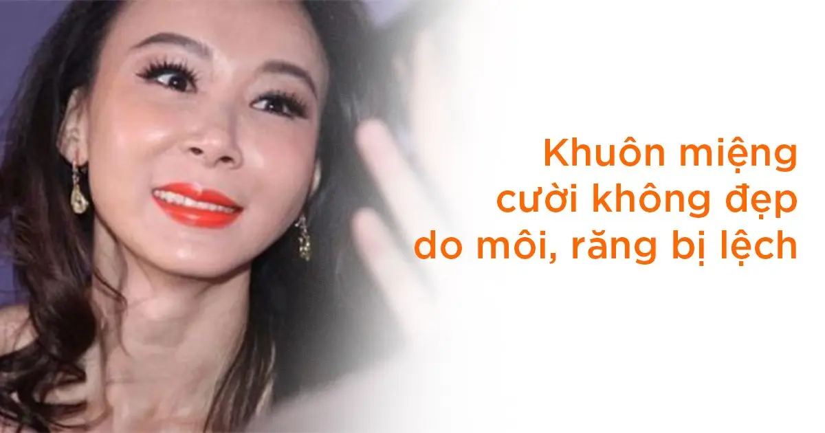 Khuôn miệng cười không đẹp do môi, răng bị lệch