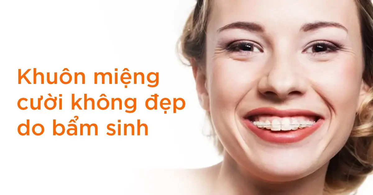 Khuôn miệng cười không đẹp do bẩm sinh