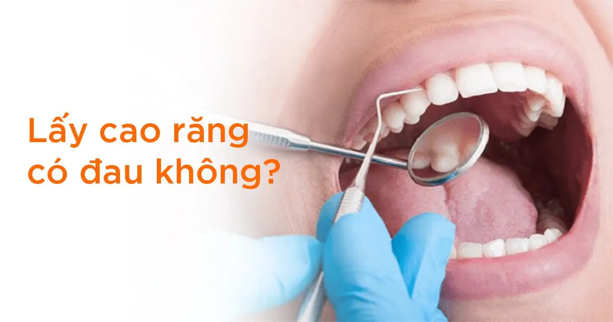 Lấy cao răng có đau không?