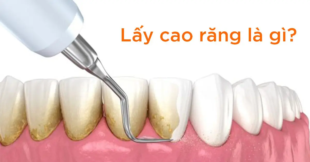 Lấy cao răng là gì?