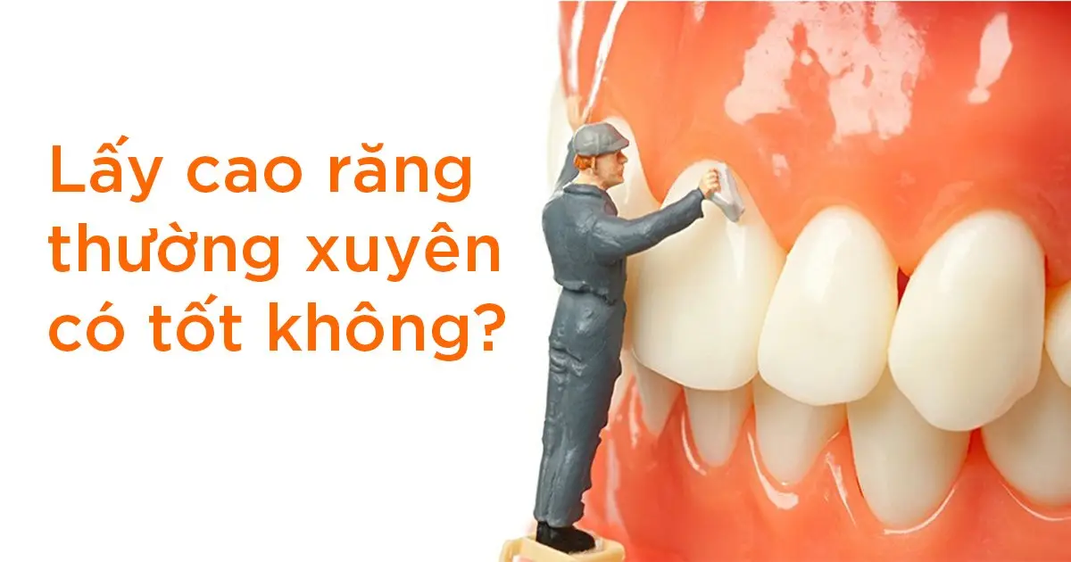 Lấy cao răng thường xuyên có tốt không?