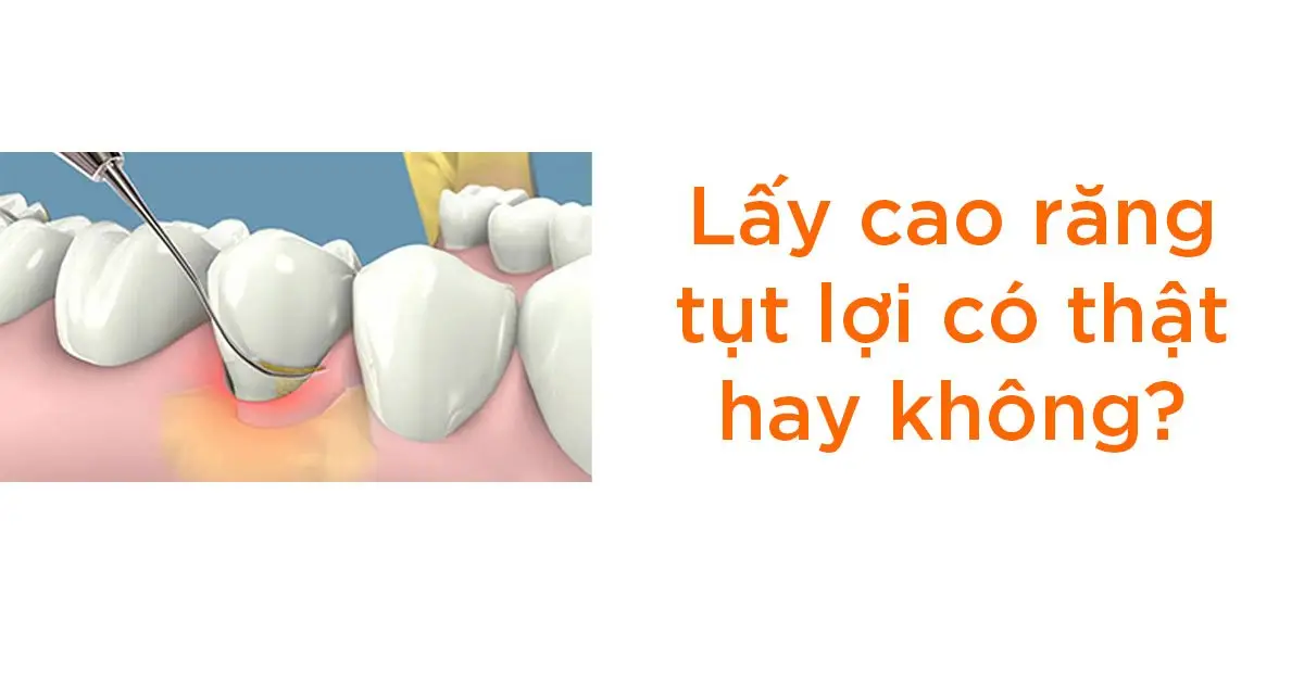 Lấy cao răng tụt lợi có thật hay không?