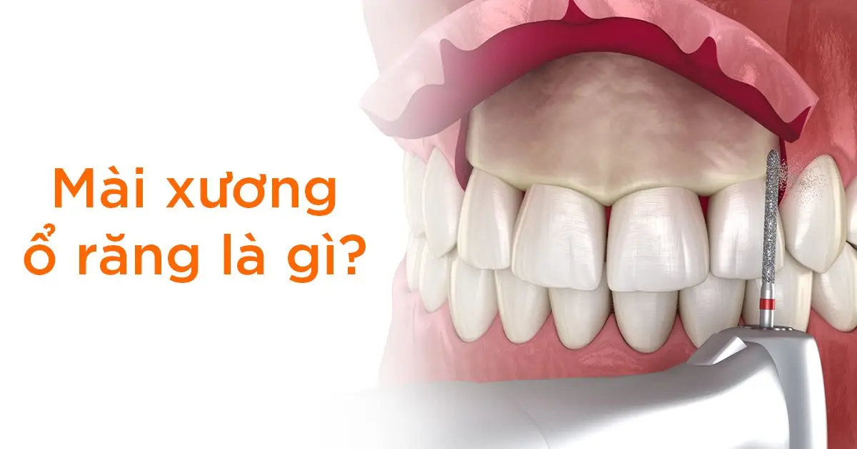 Mài xương ổ răng là gì?