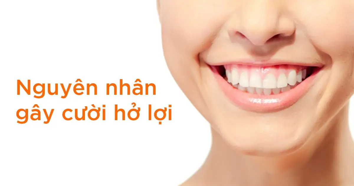 Nguyên nhân gây cười hở lợi