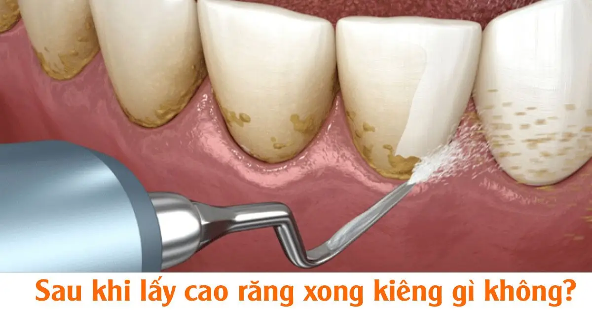 Sau khi lấy cao răng xong kiêng gì không?