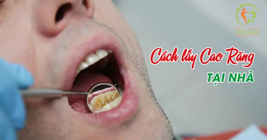 Tẩy mảng bám răng tại nhà