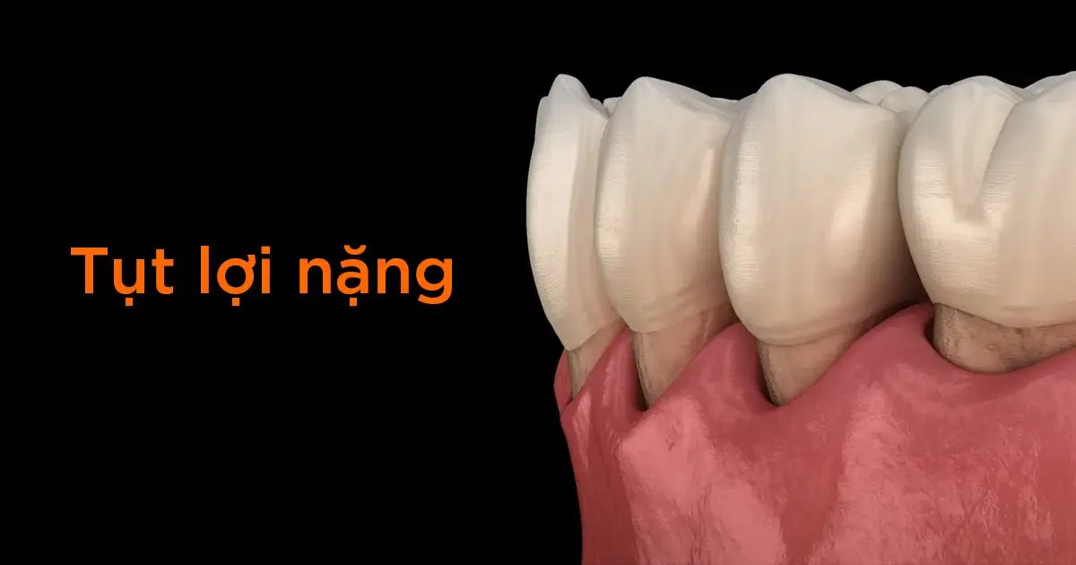 Tụt lợi nặng