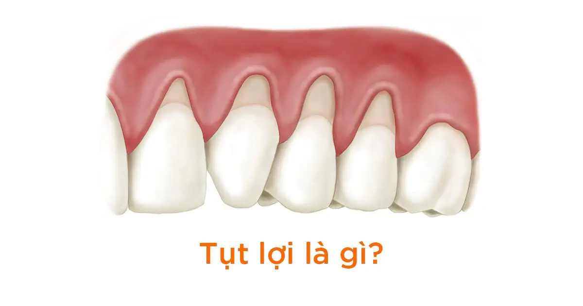 Tụt lợi là gì?