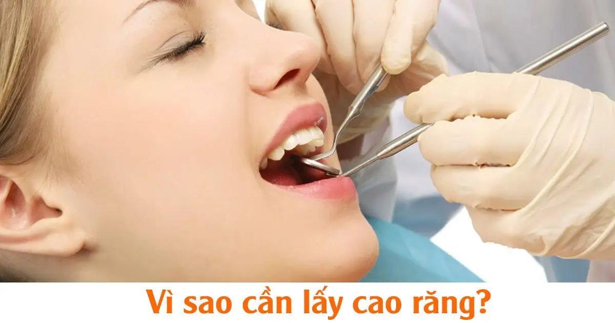 Vì sao cần lấy cao răng?