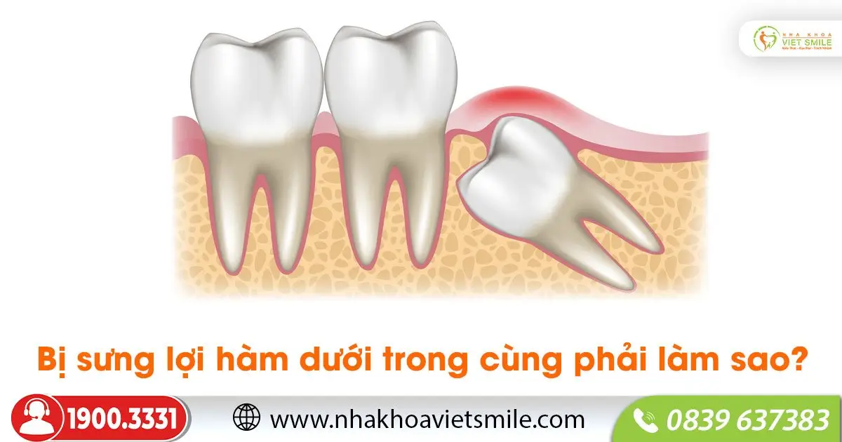 Bị sưng lợi hàm dưới trong cùng phải làm sao?