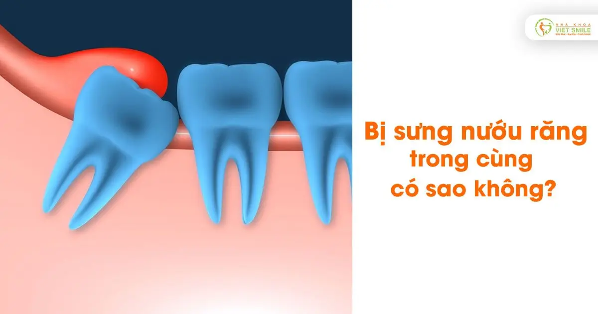 Bị sưng nướu răng trong cùng có sao không?