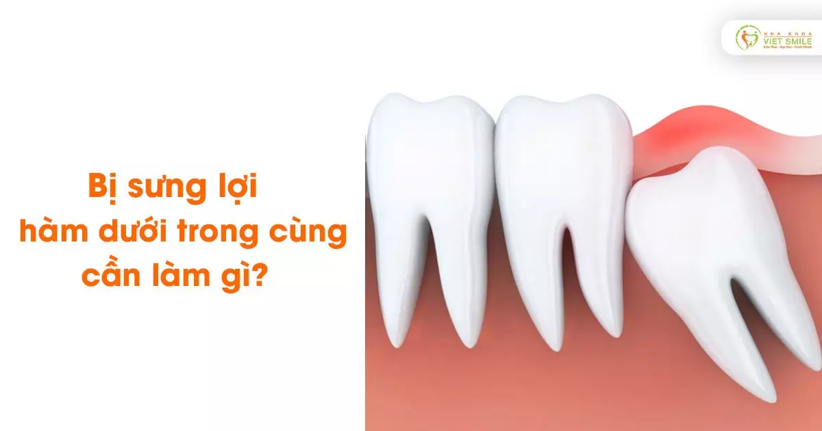 Bị sưng lợi hàm dưới trong cùng cần làm gì?
