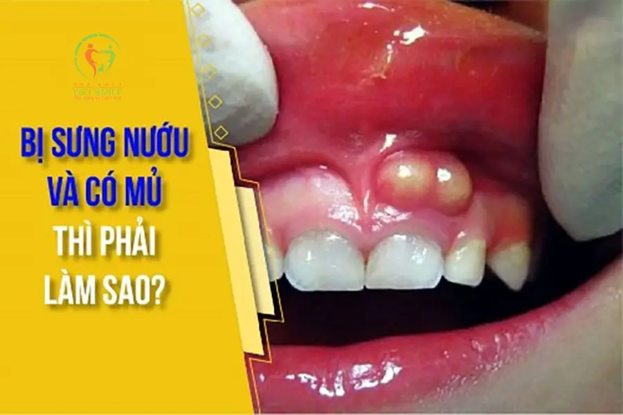 cách chữa trị viêm chân răng có mủ