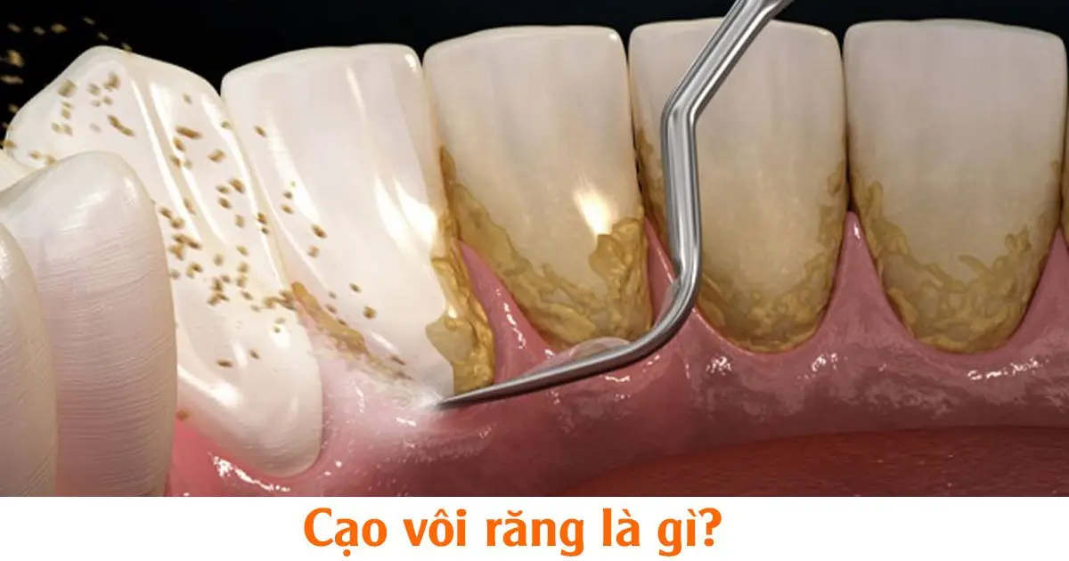 Cạo vôi răng là gì?