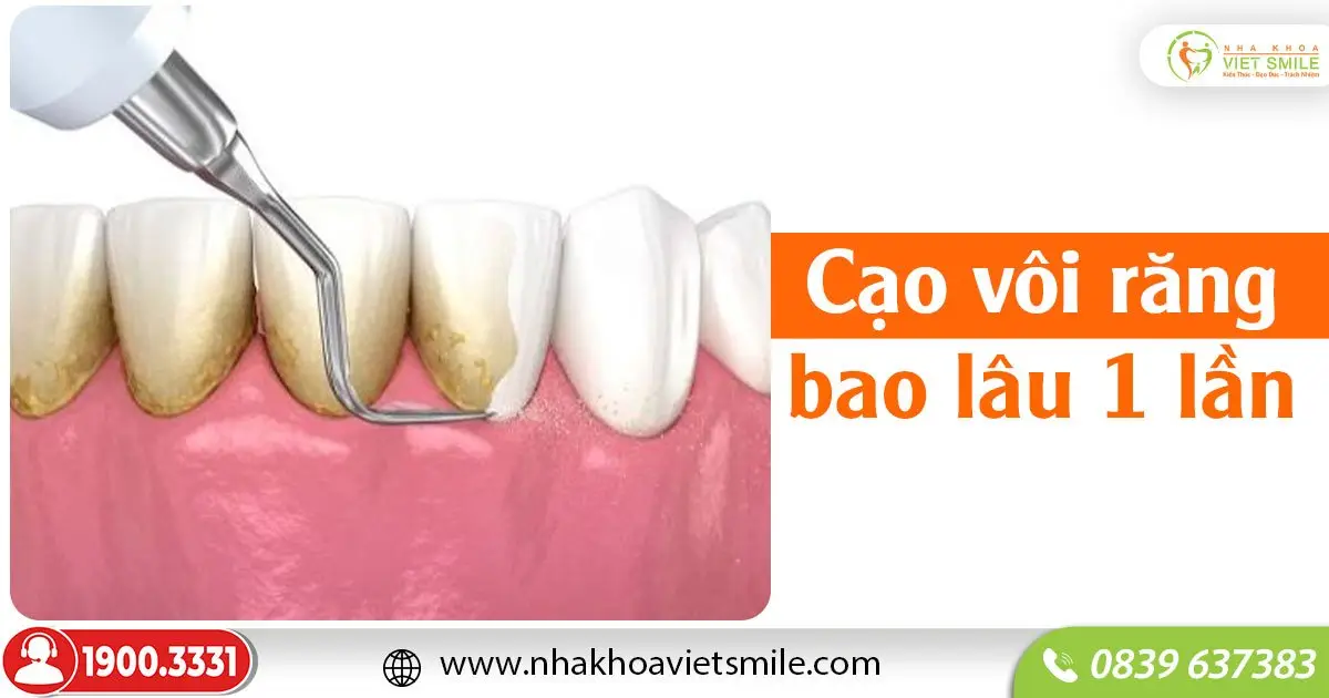 Bao lâu nên cạo vôi răng bao lâu 1 lần