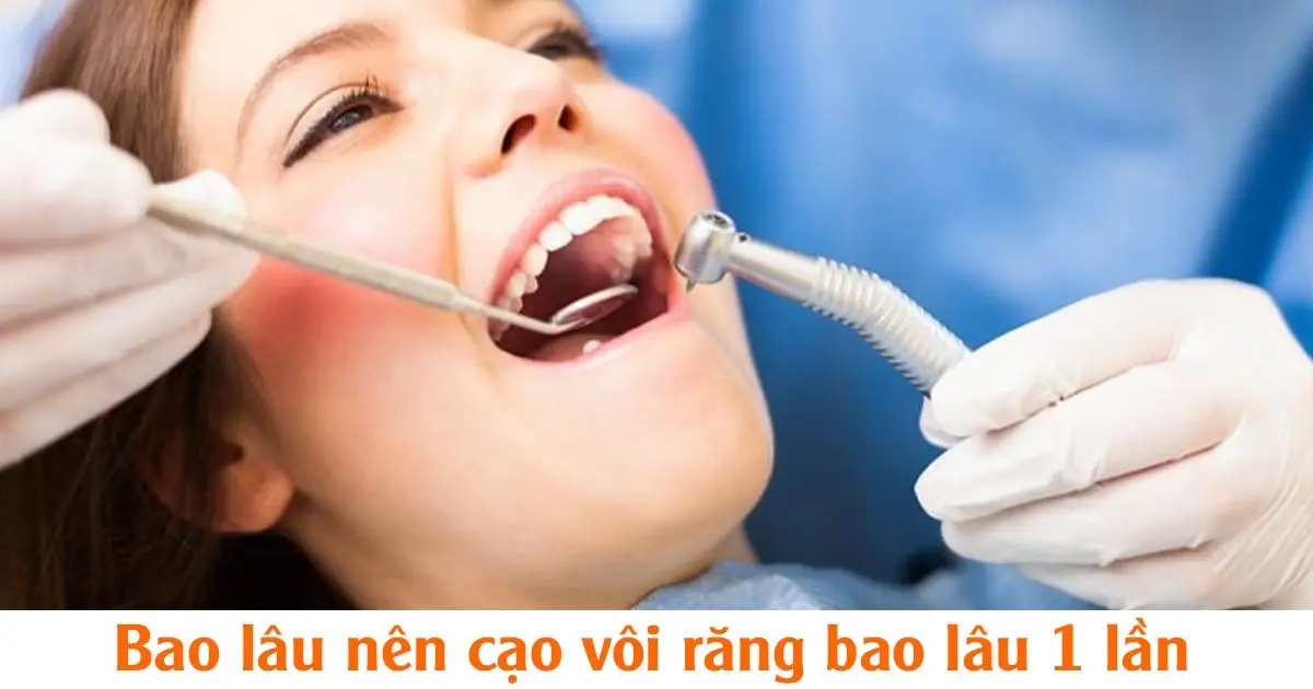 Bao lâu nên cạo vôi răng bao lâu 1 lần