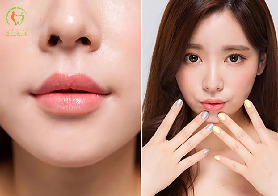 Chỉnh dáng môi để chữa méo miệng