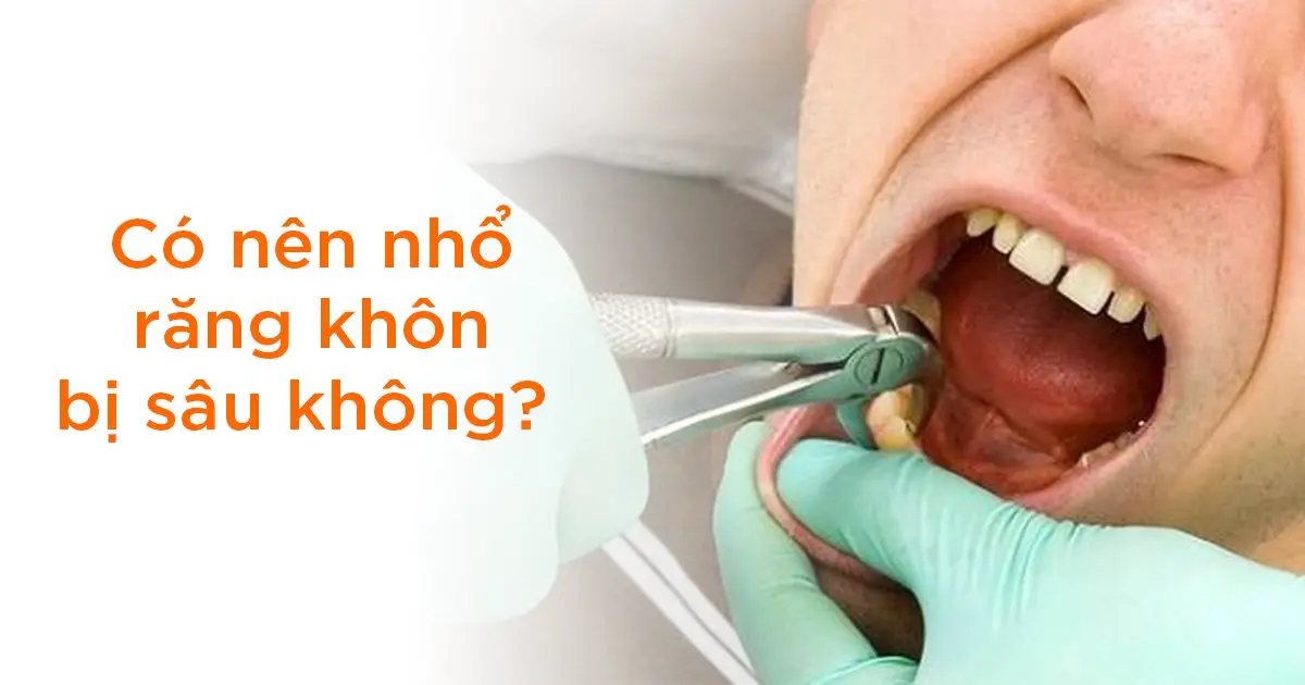 Có nên nhổ răng khôn bị sâu không?