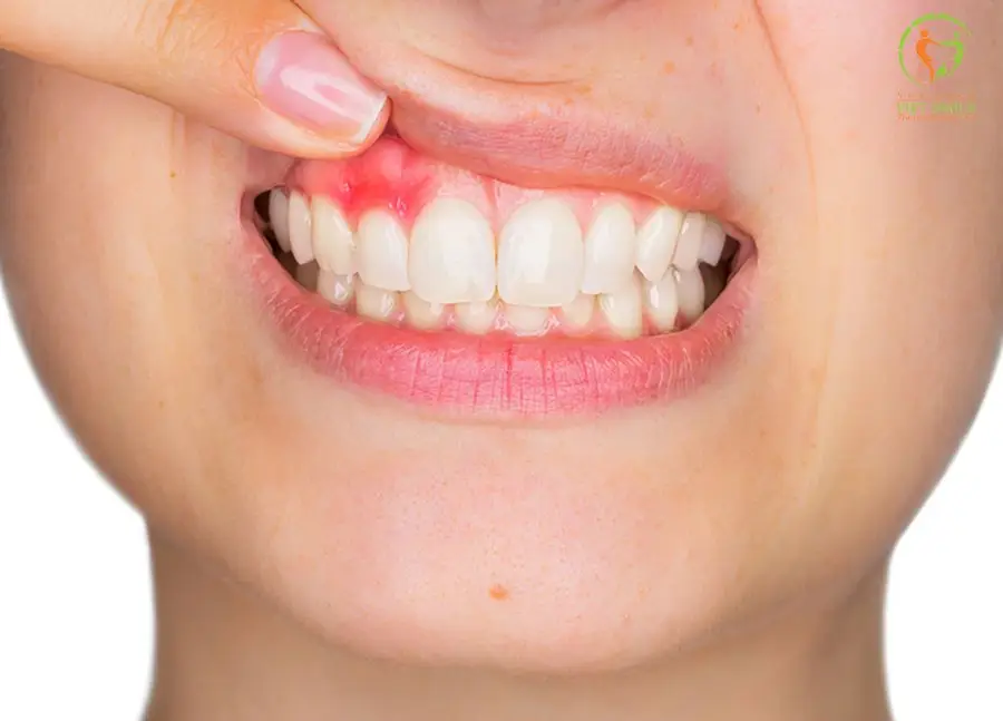 Dấu hiệu nhận biết bệnh viêm nướu có mủ